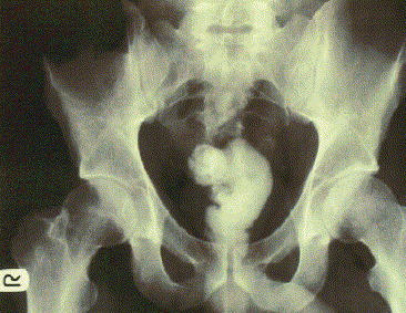 Plain abdominal-radiograph showing the impacted material.